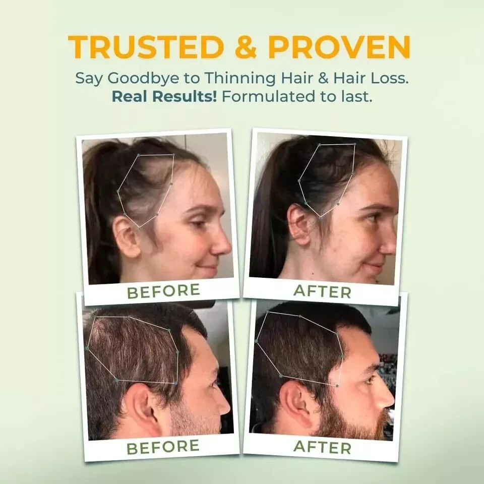 Vital Hair Complex – Biotin & B Vitamin Hair Supplement for Women & Men – Health